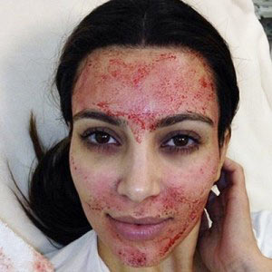 Austin Micro-Needling Treatments - Micro-Needle Experts