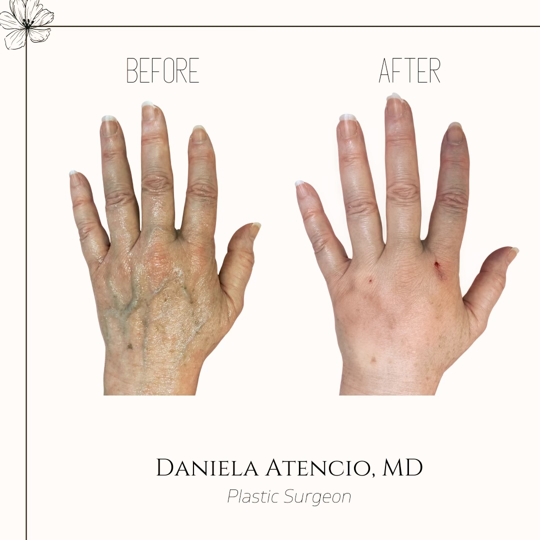 Before and after hand filler with Radiesse-Atencio Before And After Hand Filler With Radiesse Atencio