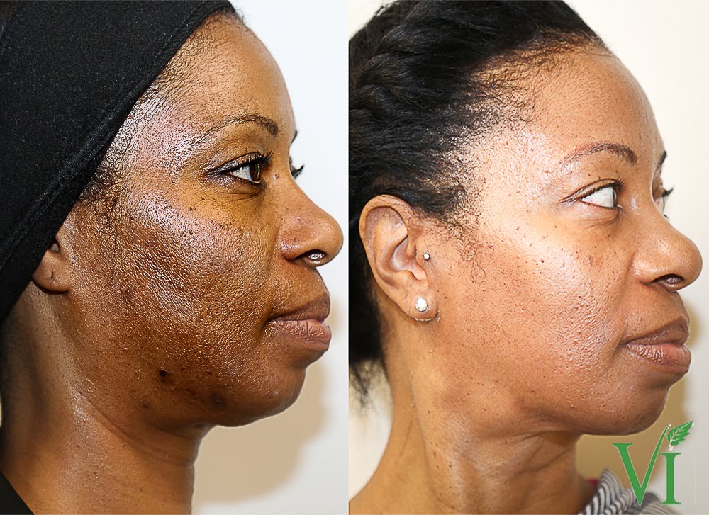 Pigmentation (4) Pigmentation 4