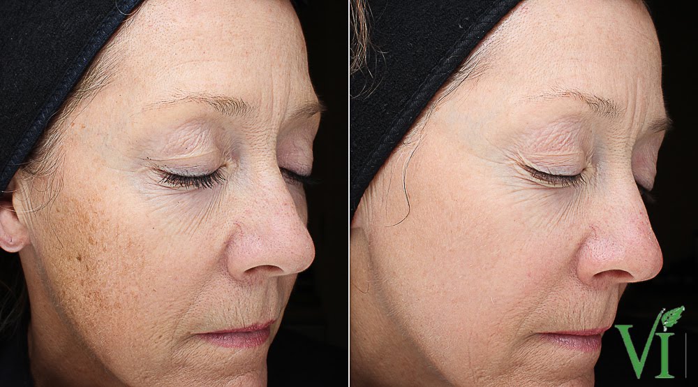 Pigmentation Pigmentation