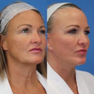 Before and After Surgical Face and Necklift Atencio