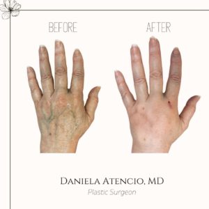 Before and after hand filler with Radiesse Atencio 1