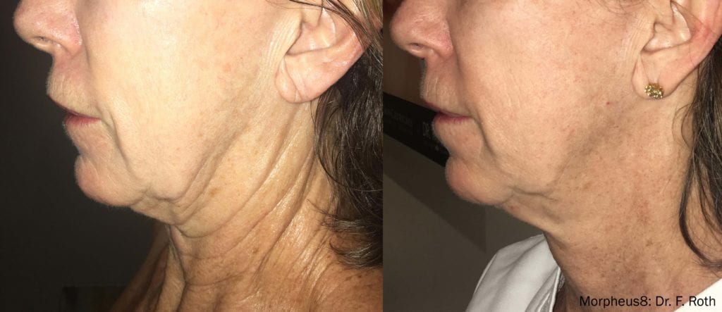 woman before and after morpheus8 treatment with neck much tighter after procedure
