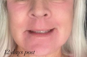 after laser resurfacing by Courtney Grant