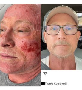 laser resurfacing courtney grant