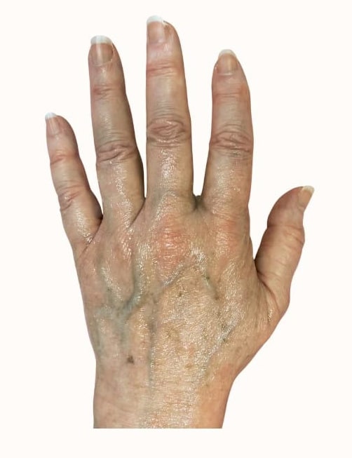 Cosmetic Filler Radiesse – Hands