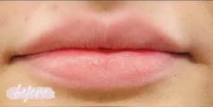 Cosmetic Filler – Lips