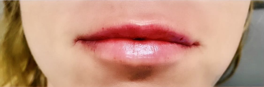 Cosmetic Filler – Lips