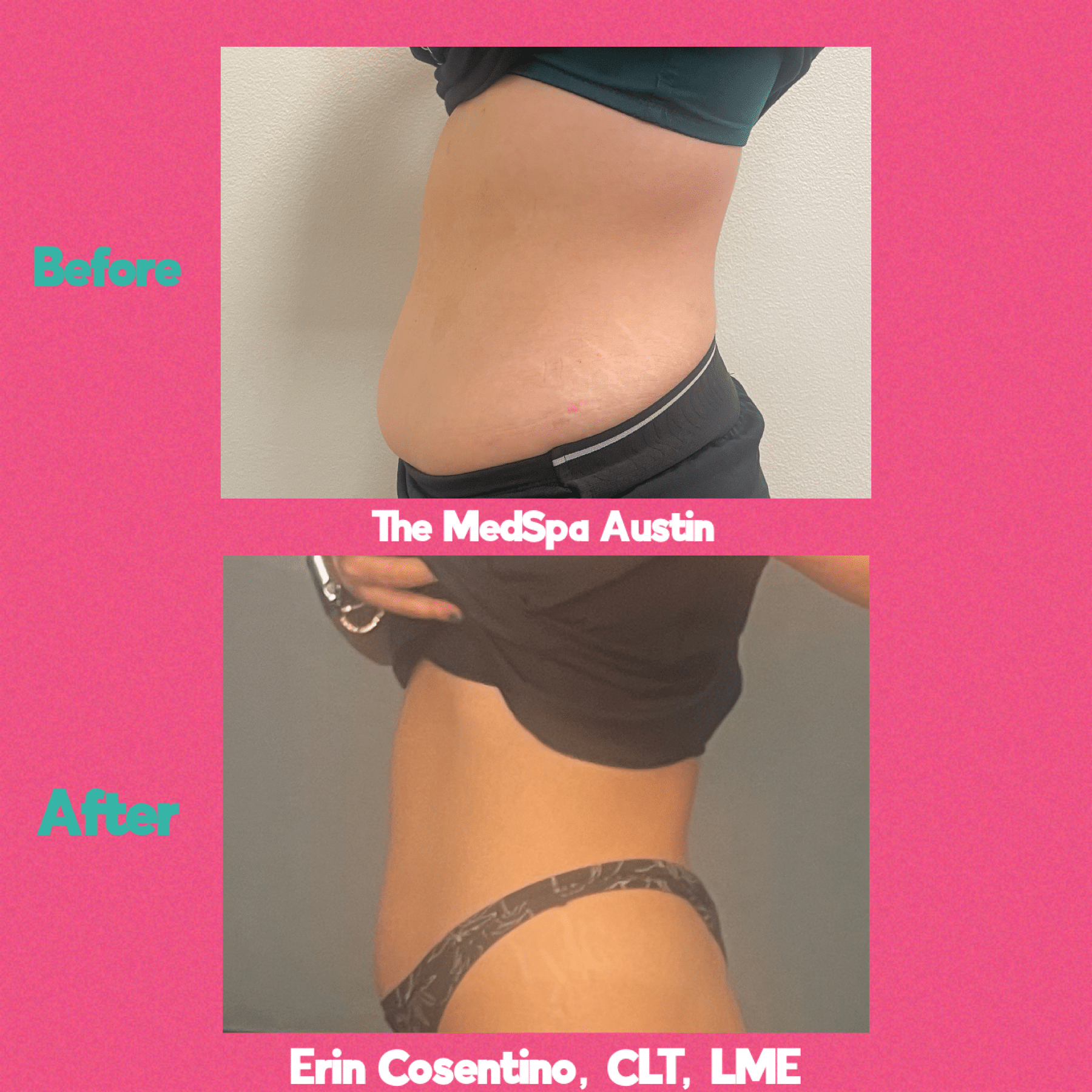 Erin Cosentino Case 1 Before and After