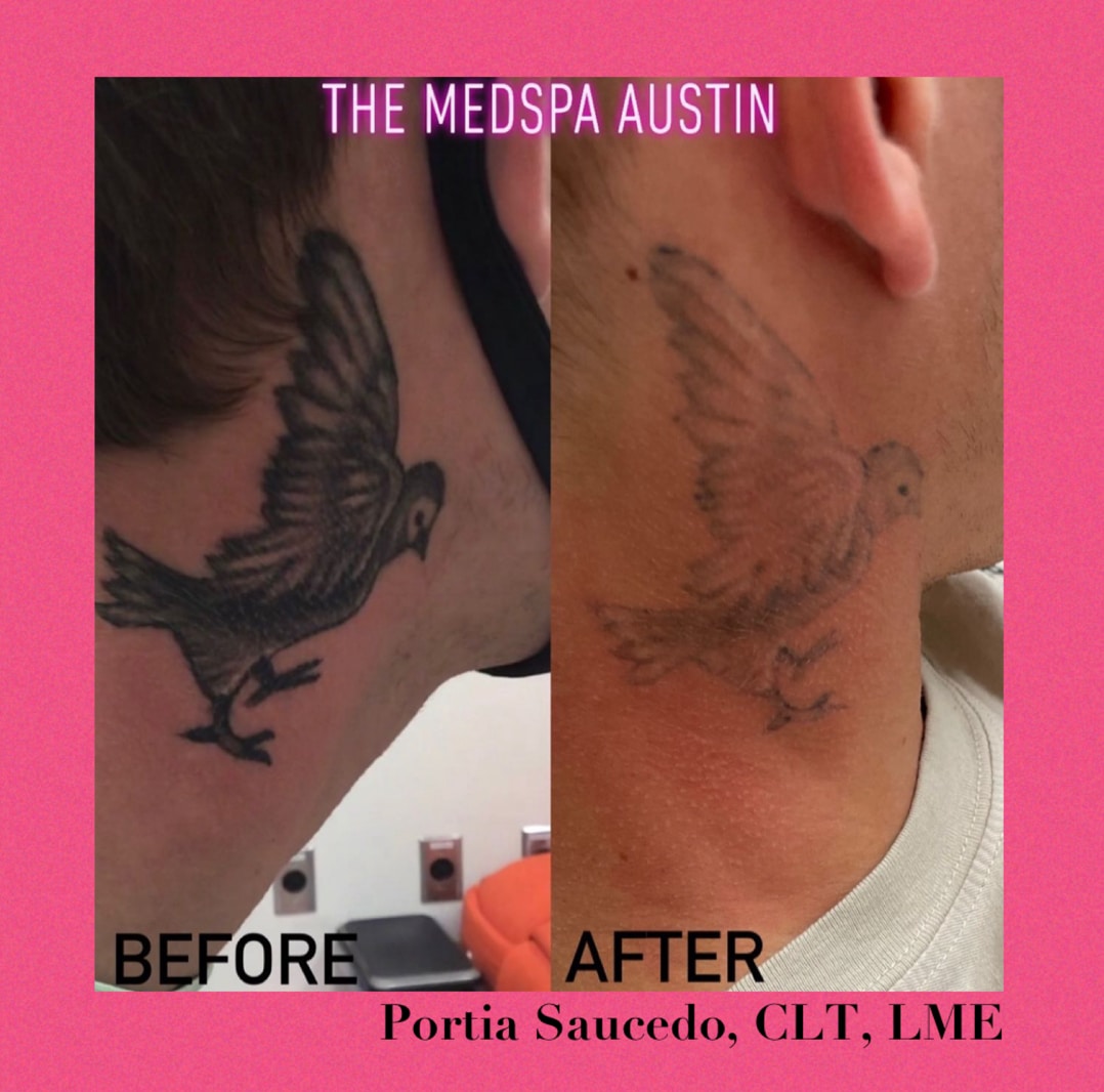 Portia Saucedo Case 1 Before & After